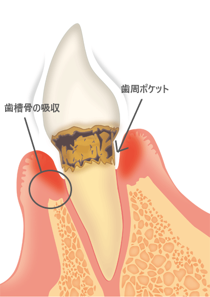 歯肉炎と歯周炎の違い|明石市大久保の徳田歯科医院